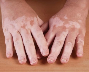 Dermatologist Guide on Vitiligo – Symptoms, Causes and Treatments